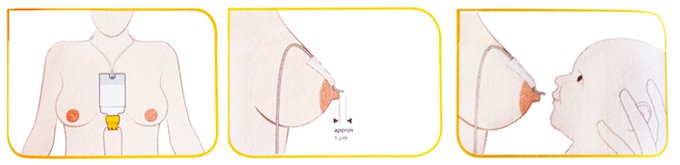 Relactador, sistema de nutrición suplementaria - Criar con Sentido Común