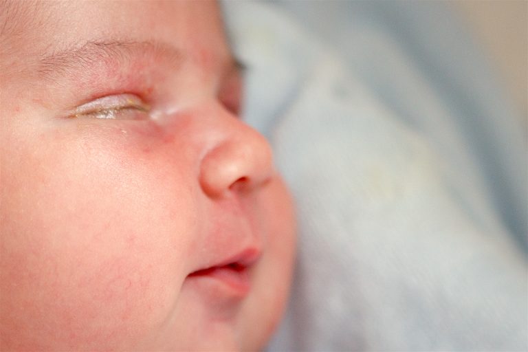 Cómo tratar la conjuntivitis en el recién nacido
