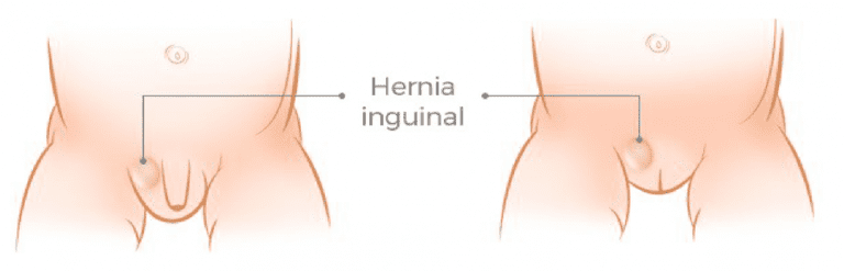 ¿Tu peque tiene un bultito en la ingle que aparece y desaparece? Puede tratarse de una hernia inguinal