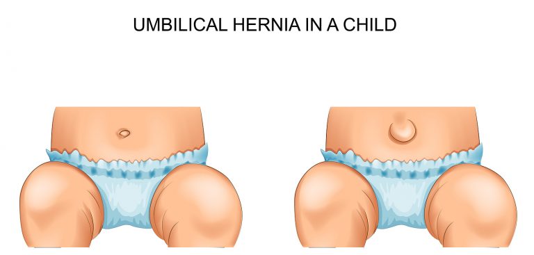 La hernia umbilical en el bebé