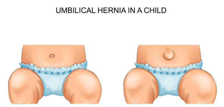 La hernia umbilical en el bebé