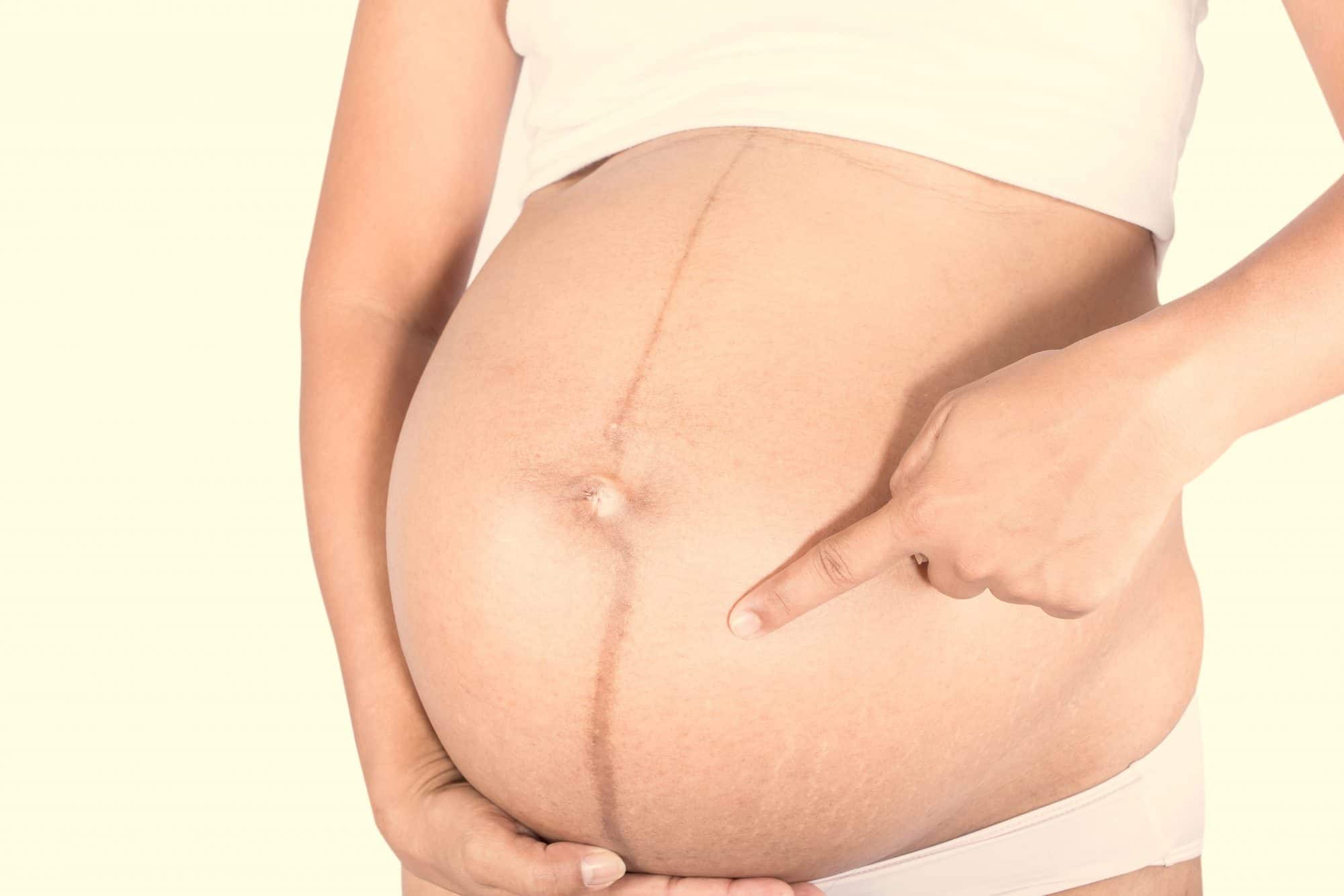 insondable preámbulo trabajo duro Estrías en el embarazo: ¿pueden prevenirse? - Criar con Sentido Común