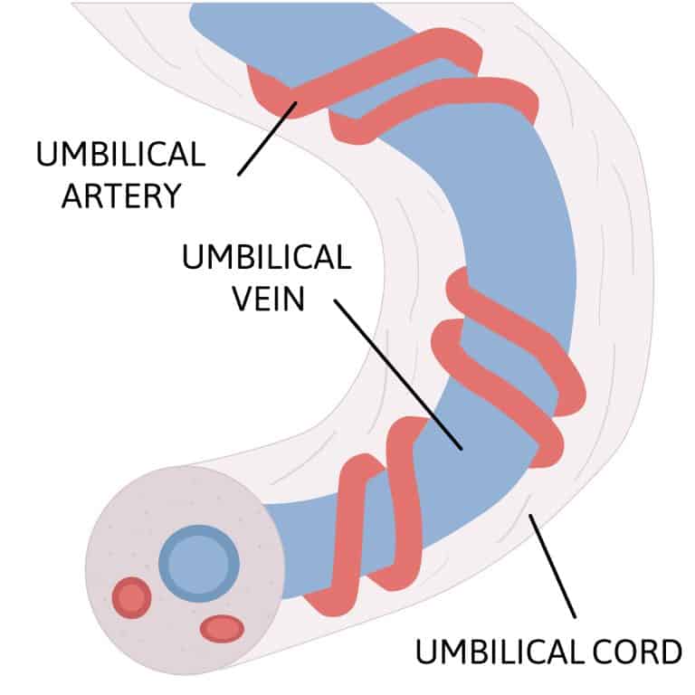 Cordón umbilical corto en el embarazo