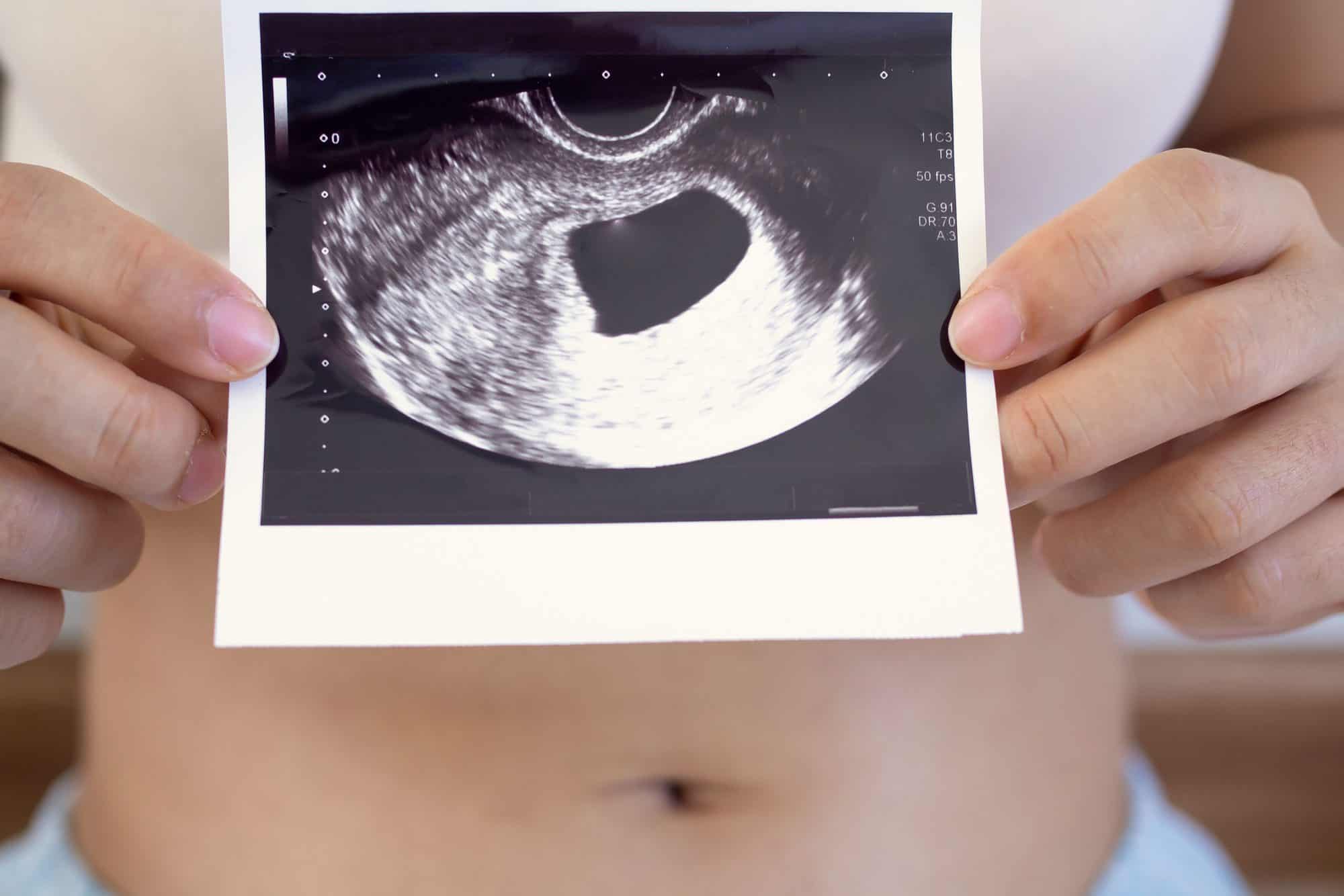 ¿Por qué se produce un embarazo anembrionario?