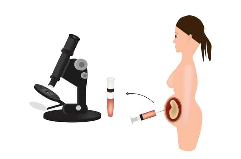 Biopsia corial y amniocentesis: ¿Qué son y para qué sirven?