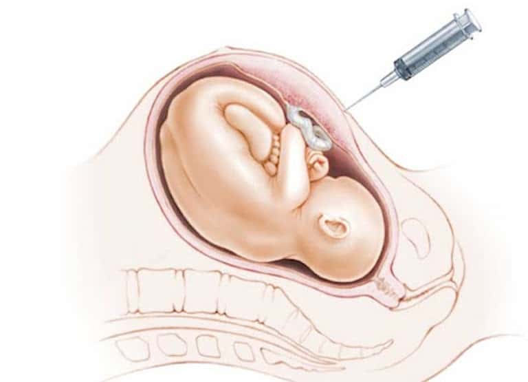 Biopsia corial y amniocentesis: ¿Qué son y para qué sirven?