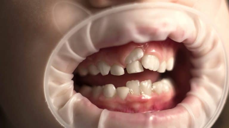 ¿Qué son los dientes de tiburón en niños?