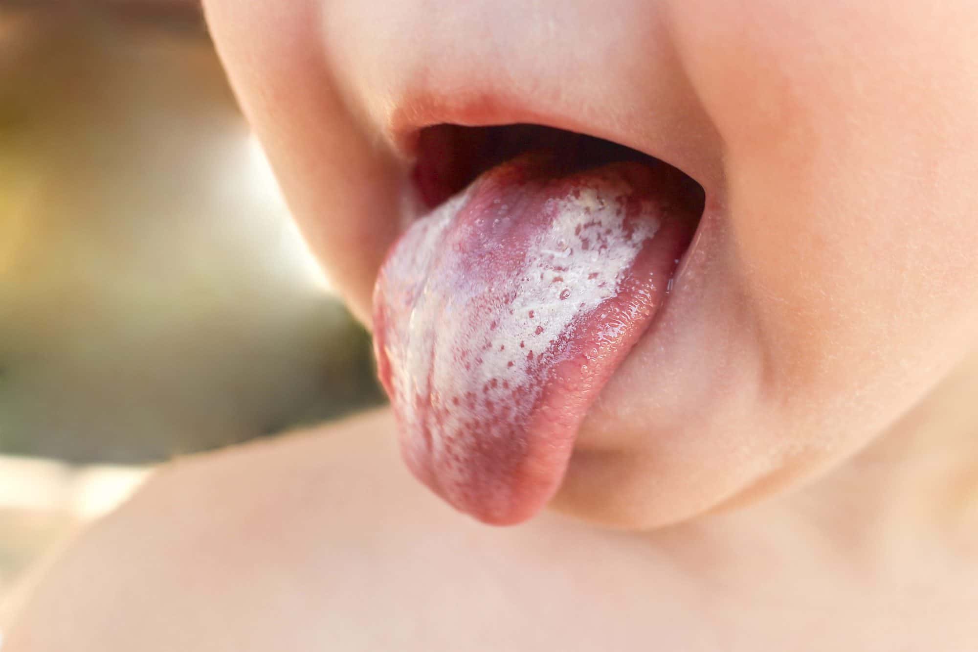 ¿Qué pasa si mi bebé tiene la lengua blanca?