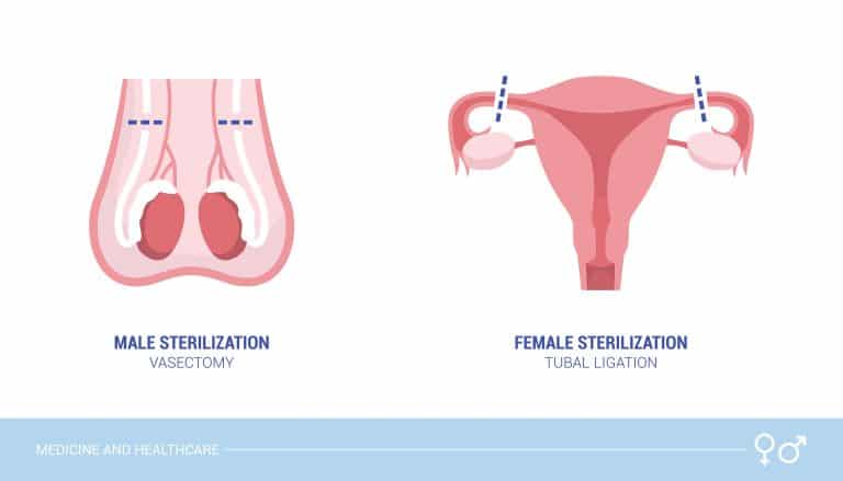 ¿Qué es mejor la ligadura de trompas o la vasectomía?