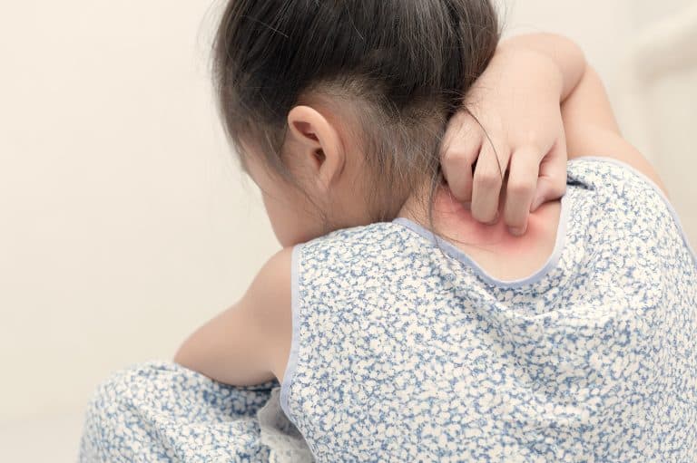 Psoriasis en los niños: Causas, síntomas y tratamiento