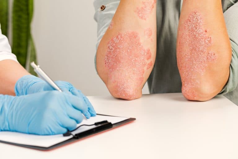 Psoriasis en los niños: Causas, síntomas y tratamiento