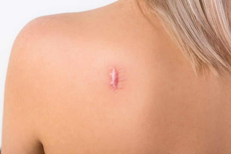 Cómo saber si una herida necesita puntos de sutura