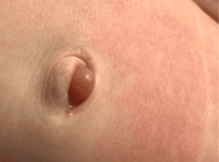 Granuloma umbilical: ¿Qué es? ¿Cómo se cura?