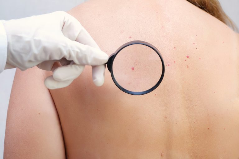 Melanoma infantil: Síntomas y tratamiento