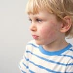 ¿Qué pruebas haya para realizar un diagnóstico de alergia a niños?