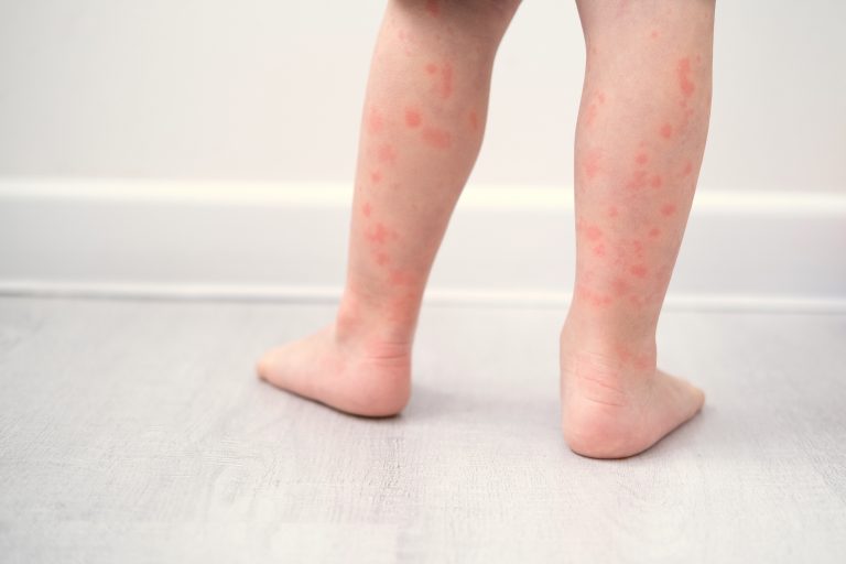 ¿Qué pruebas haya para realizar un diagnóstico de alergia a niños?