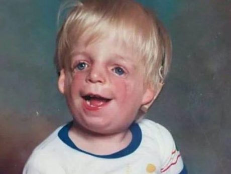 Síndrome de Treacher Collins Síndrome de Treacher Collins en recién nacidos