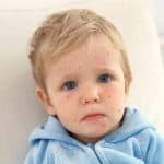 Varicela en niños: Síntomas y tratamiento