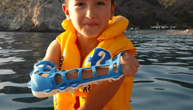 Bañarse con brazo roto ya es posible gracias a las férulas en 3D