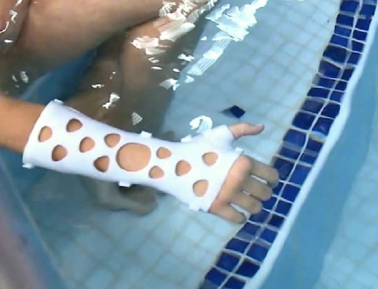 Bañarse con brazo roto ya es posible gracias a las férulas en 3D