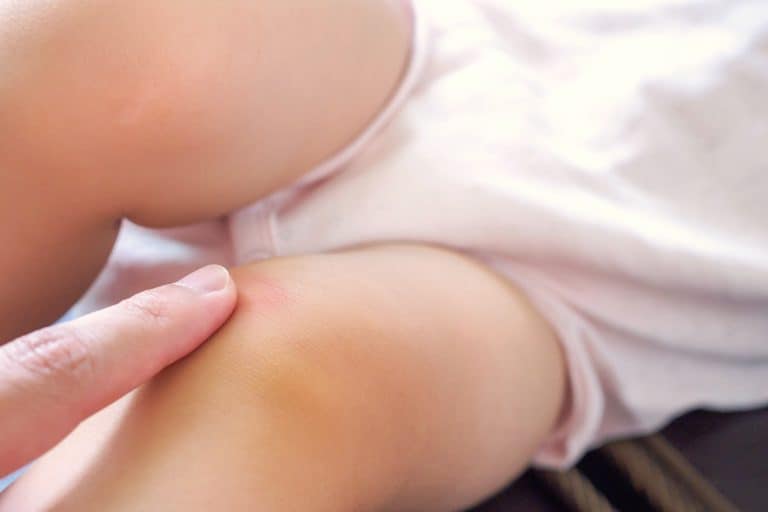 Petequias en un bebé: Tipos, síntomas, causas y tratamiento