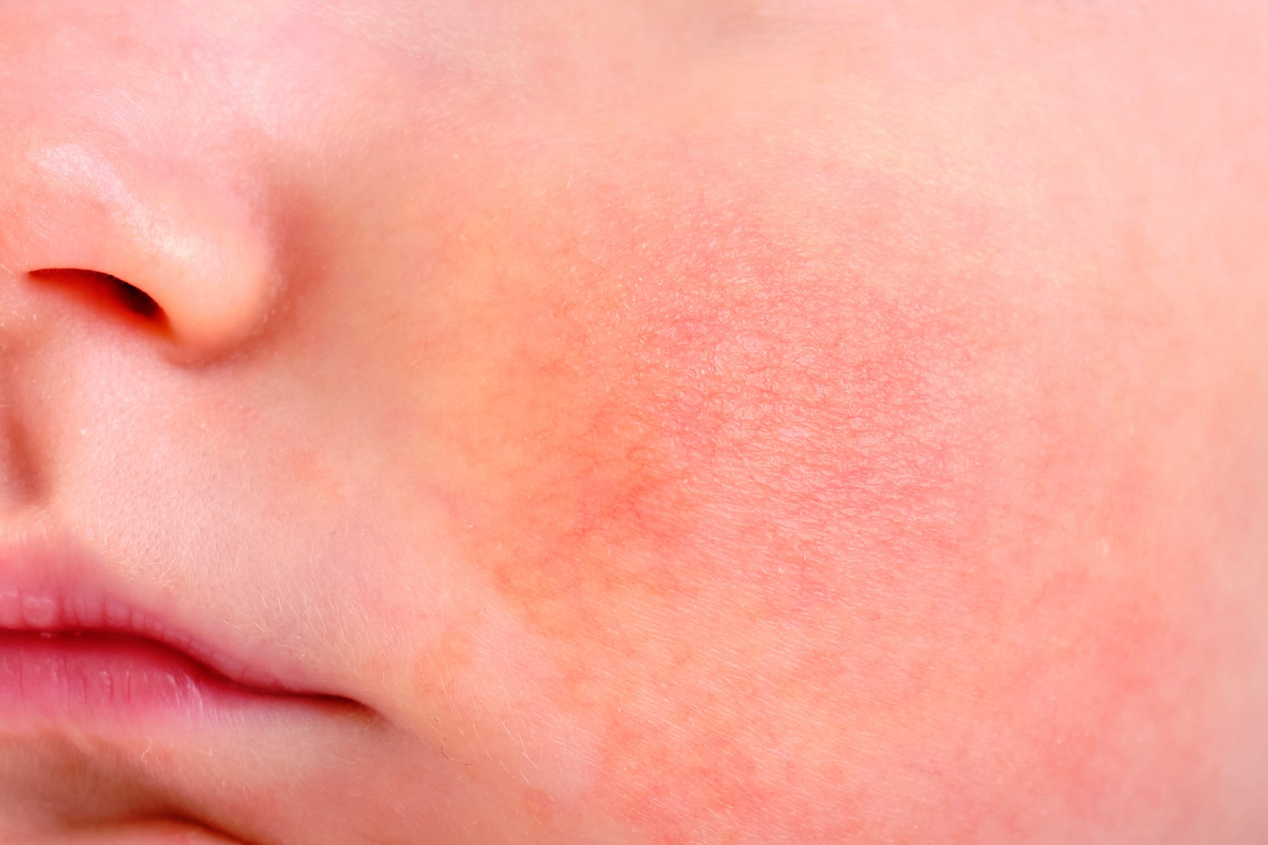 ¿Cómo sé si mi bebé tiene eczema?