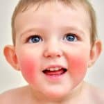 Megaloeritema en niños - Eritema infeccioso infantil