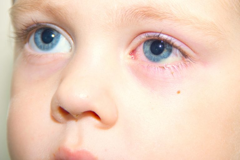 Limpieza y cuidados de los ojos en niños