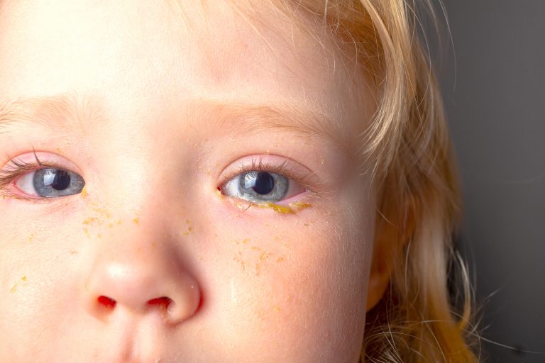 Limpieza y cuidados de los ojos en niños