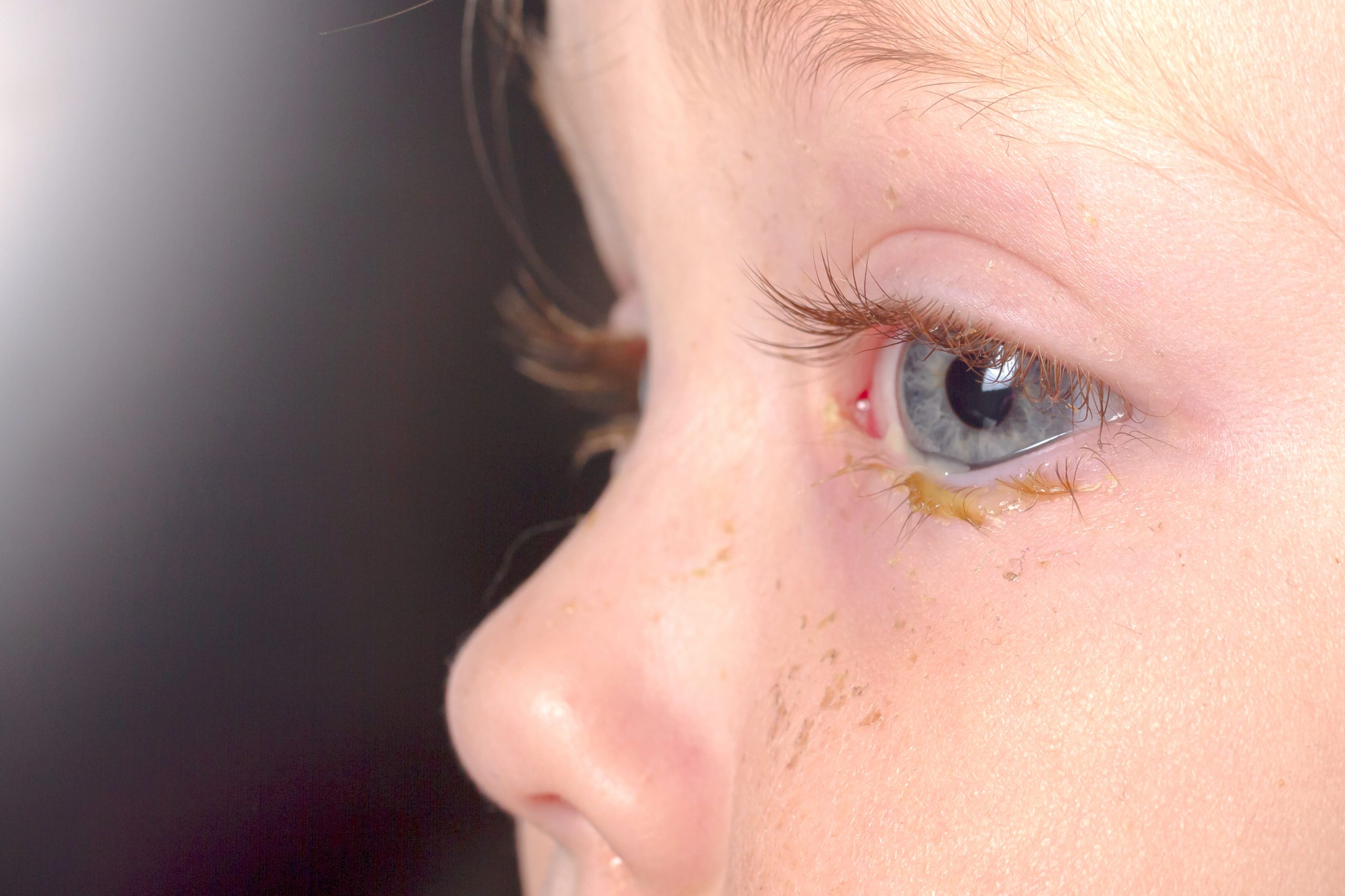 Suero fisiológico: Lavado de los ojos y la nariz del bebé