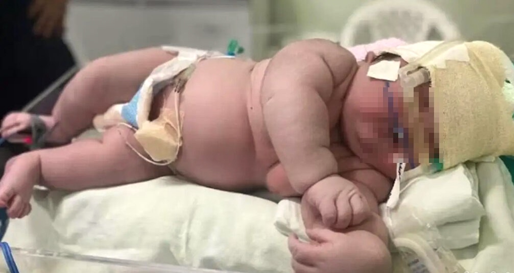 ¿Qué pasa cuando un bebé es macrosómico?