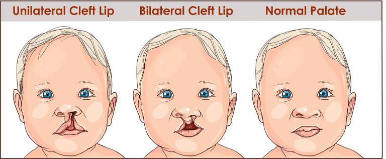 Labio leporino: Causas, consecuencias y solución