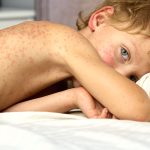 La OMS alerta del incremento del sarampión en Europa