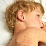 Más riesgo de depresión en niños con dermatitis atópica