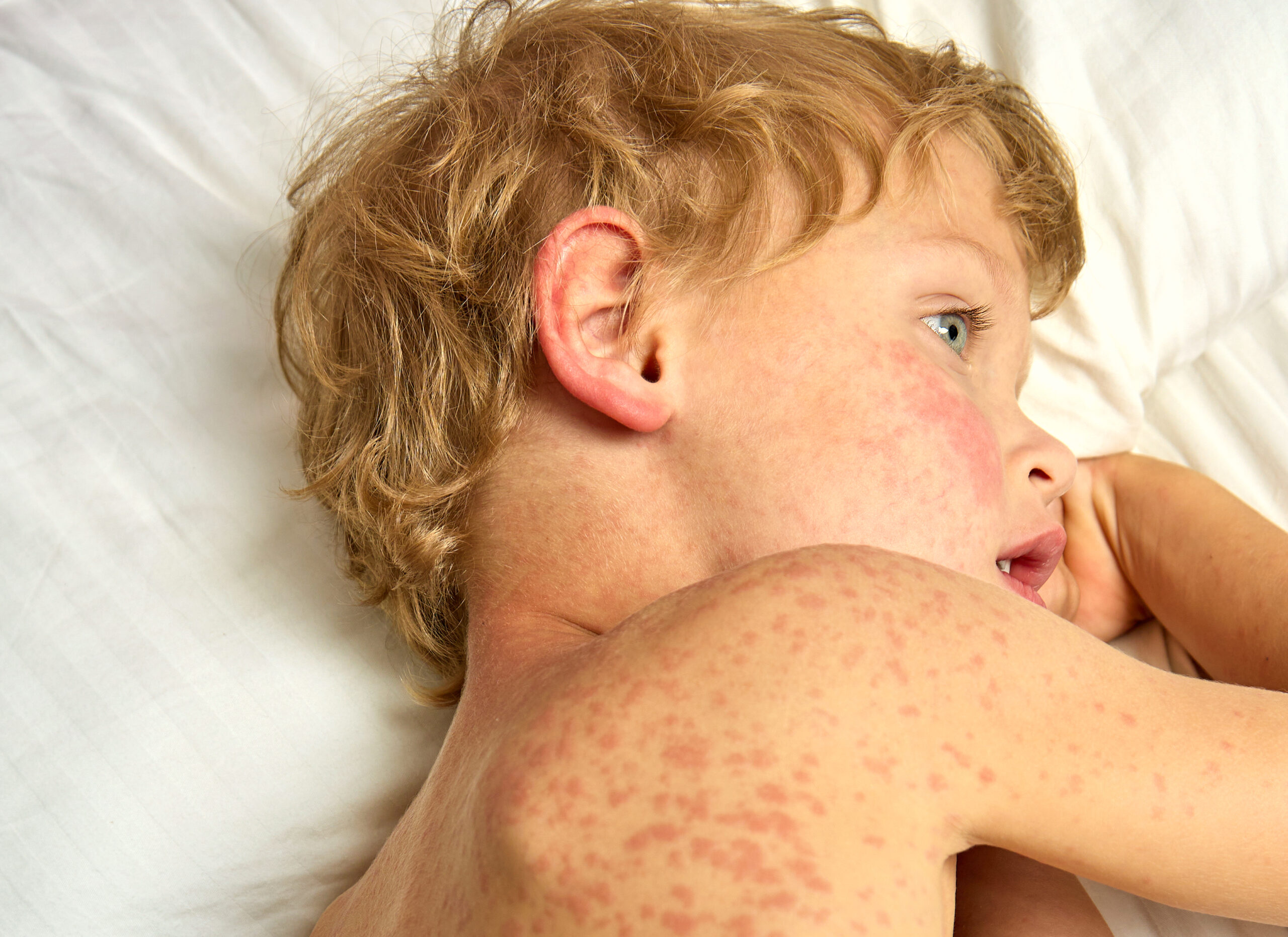 Más riesgo de depresión en niños con dermatitis atópica