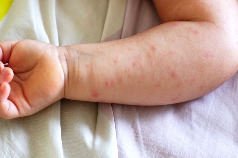 Más riesgo de depresión en niños con dermatitis atópica