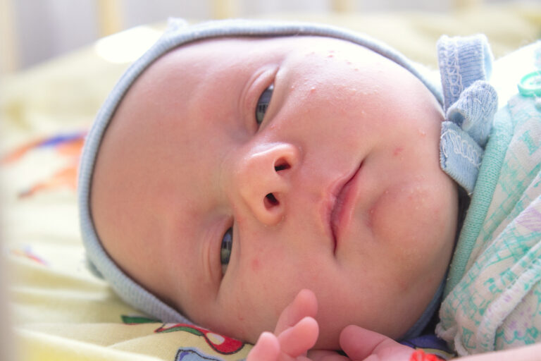 Sepsis y microbioma en bebés prematuros