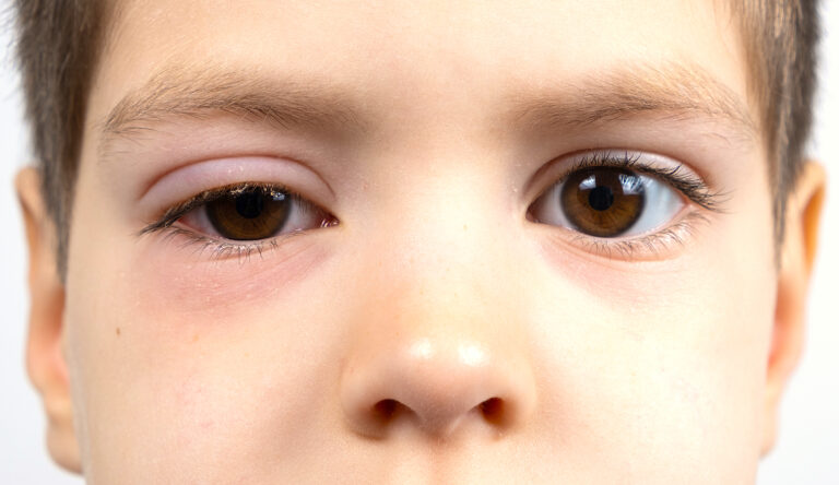 Piscina y conjuntivitis en niños