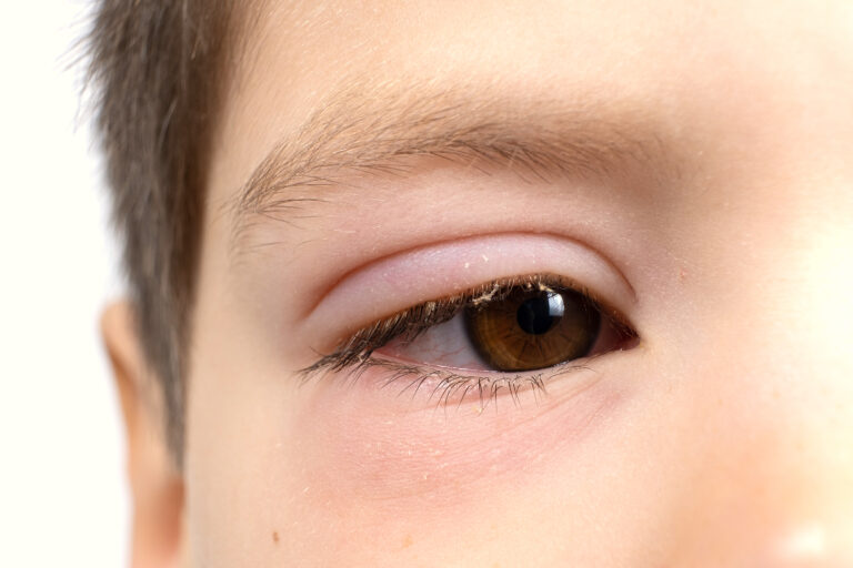 Piscina y conjuntivitis en niños