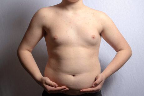 Más de 124 millones de niños obesos en todo el mundo