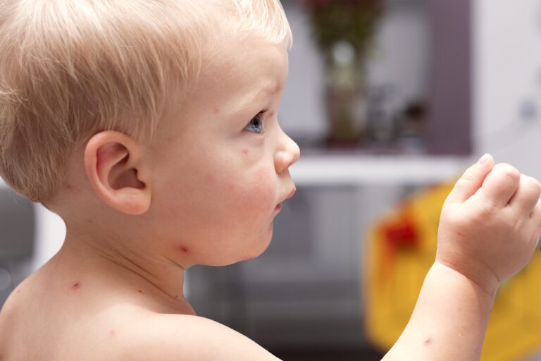 Varicela en bebés sin vacunar