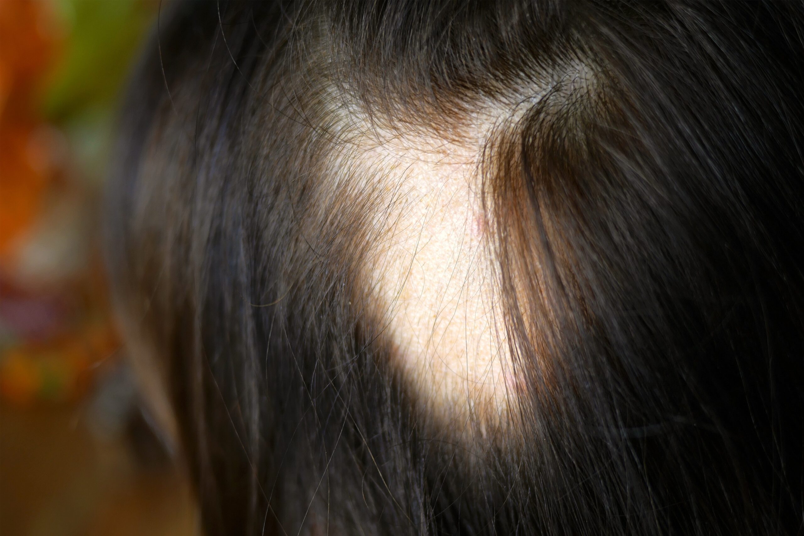 ¿Cómo se cura la alopecia areata en niños?