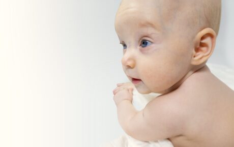 Progeria del recién nacido o síndrome de Hutchinson-Gilford